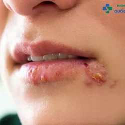 [Gỡ rối thắc mắc] Bệnh lậu có nguy hiểm không?