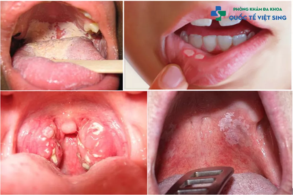 Các triệu chứng khi bị nhiễm khuẩn lậu ở miệng