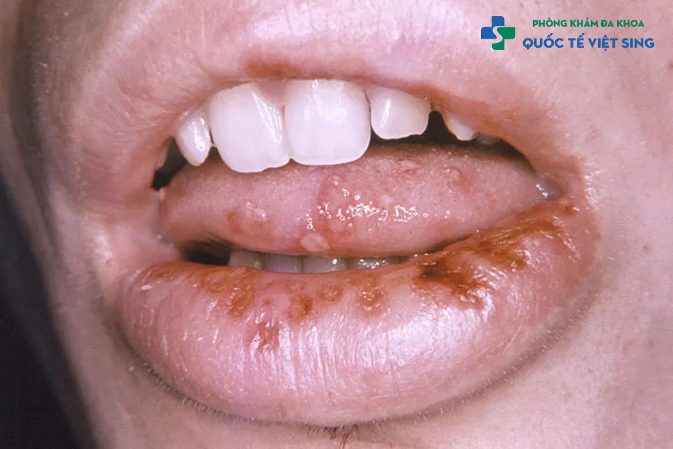 Triệu chứng nhận biết bệnh lậu ở lưỡi