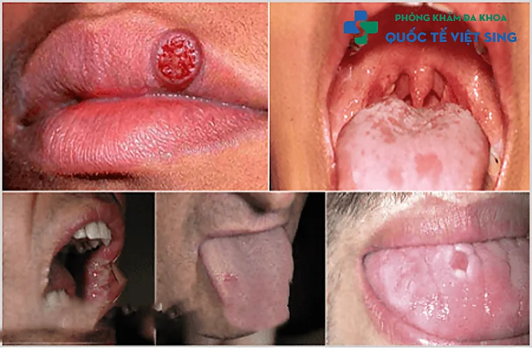 Nguyên nhân và triệu chứng nhận biết bệnh giang mai ở miệng