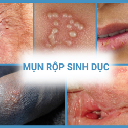 Gợi ý Top 10 địa chỉ phòng khám mụn rộp sinh dục Bắc Ninh uy tín, an toàn