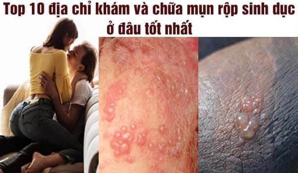 Top 10 địa chỉ phòng khám mụn rộp sinh dục Bắc Ninh
