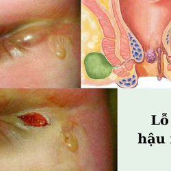 Top 10 địa chỉ phòng khám chữa rò hậu môn ở Bắc Ninh uy tín nhất