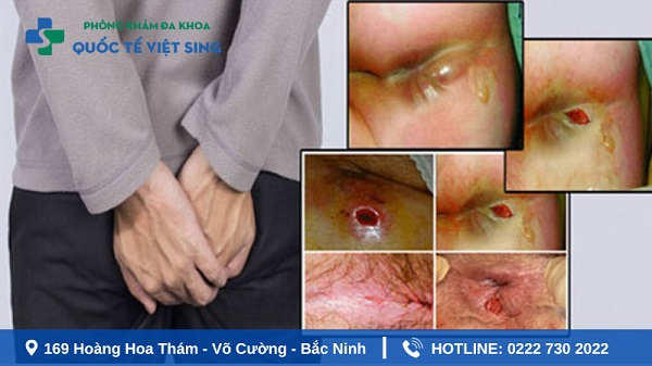 Top 10 địa chỉ phòng khám chữa áp xe hậu môn ở Bắc Ninh [Cập nhật 2025]