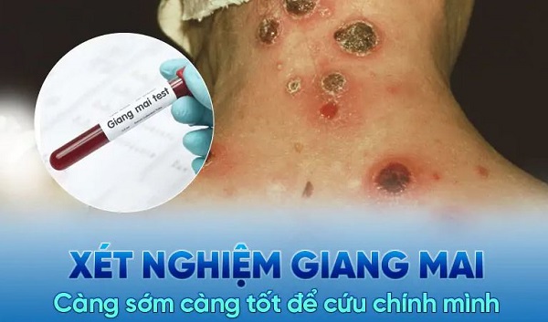 [Tham khảo] Top 10 địa chỉ phòng khám giang mai bắc ninh