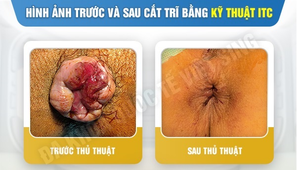 Tất tần tật về phương pháp cắt trĩ bằng sóng cao tần ITC