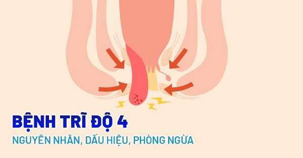 Trĩ cấp độ 4 là gì? Triệu chứng, nguy cơ và cách điều trị hiệu quả