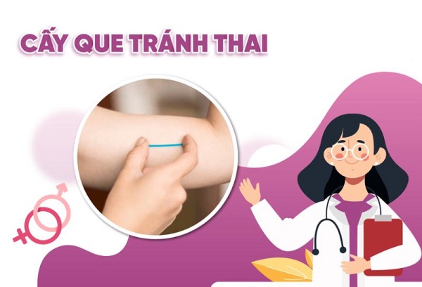 Chi phí cấy que tránh thai ở Bắc Ninh : 10+ địa chỉ uy tín giá rẻ