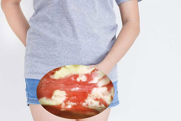 Top 10 địa chỉ chữa nấm âm đạo Bắc Ninh uy tín, bảo mật, chi phí hợp lý