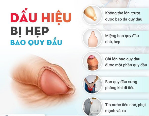 Nguyên nhân hẹp bao quy đầu ở người lớn và cách khắc phục hiệu quả