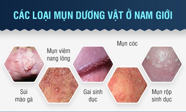 Chữa dương vật mọc mụn Bắc Ninh ở đâu tốt? Top 10+ địa chỉ bạn nên chọn