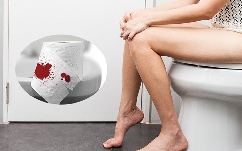 Đi ngoài ra máu là dấu hiệu bệnh gì? Khi nào cần đi khám bác sĩ ngay?