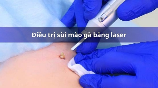 Đốt laser sùi mào gà có để lại sẹo không? Giải đáp từ chuyên gia