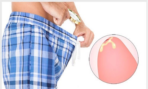 Tại sao dương vật chảy mủ xanh? 4 Nguyên nhân phổ biến nam giới cần biết