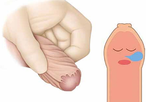 Top 10 địa chỉ nong bao quy đầu Bắc Ninh uy tín, chi phí hợp lý