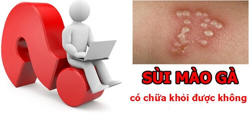 Mắc sùi mào gà có chữa khỏi được không hay sống chung cả đời?