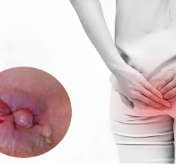 Bị trĩ lòi ra ngoài phải làm sao? Hướng dẫn từ A đến Z để giảm khó chịu