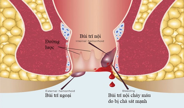 Điều trị trĩ nội chảy máu bằng cách nào hiệu quả? Lời khuyên từ chuyên gia