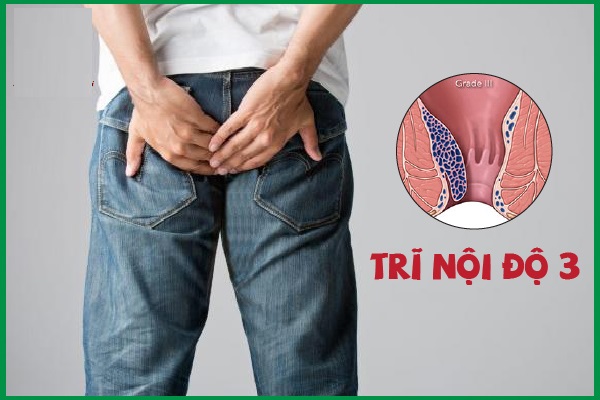 Trĩ nội độ 3 là gì? Dấu hiệu nhận biết và cách điều trị an toàn