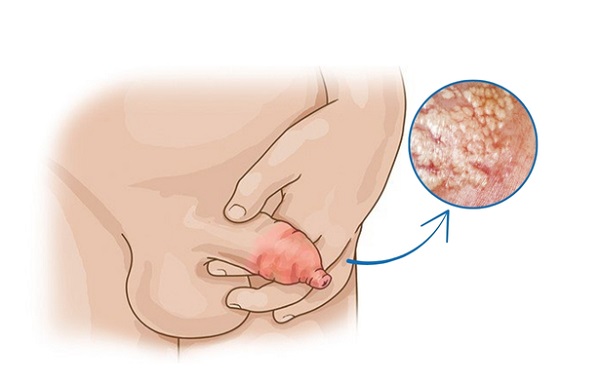 Nguyên nhân dài bao quy đầu ở nam giới: Do bẩm sinh hay bệnh lý tiềm ẩn?