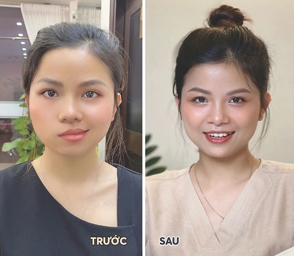 Trải nghiệm: Phục hồi méo miệng nhờ châm cứu sau tai biến tại Việt Sing Bắc Ninh