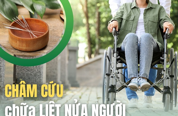 Lộ trình 30 ngày phục hồi liệt nửa người sau tai biến bằng châm cứu