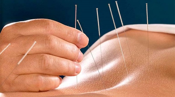 Châm cứu chữa di chứng tai biến mạch máu não: Hiệu quả đến đâu?