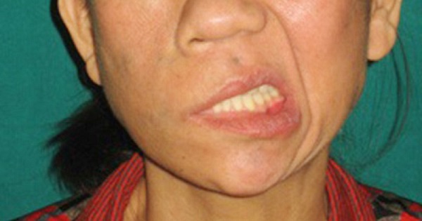 Méo miệng sau tai biến bao lâu thì châm cứu có tác dụng?