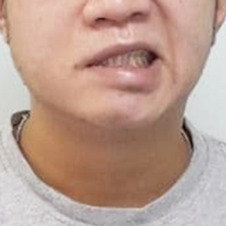 Chi phí châm cứu trị méo miệng sau tai biến hiện nay tại Bắc Ninh