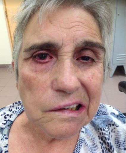 Việt Sing – Cơ sở y tế châm cứu trị méo miệng sau tai biến uy tín tại Bắc Ninh