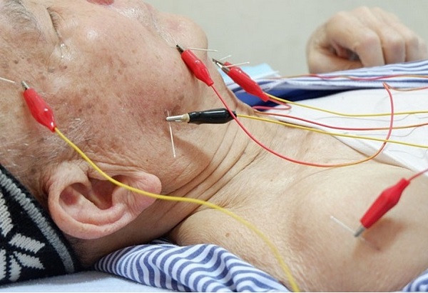 Câu chuyện thực tế: Bệnh nhân hết nói ngọng nhờ châm cứu tại Việt Sing Bắc Ninh