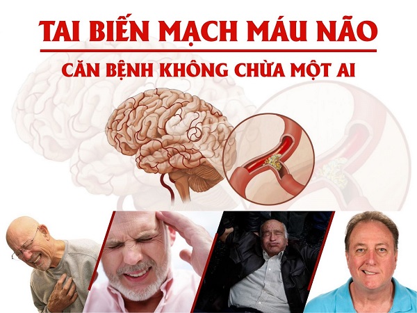Ít ai biết: Tai biến mạch máu não theo y học cổ truyền không chỉ do tuổi già