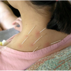 Châm cứu bị sưng có sao không? Nguyên nhân và cách xử lý an toàn tại nhà