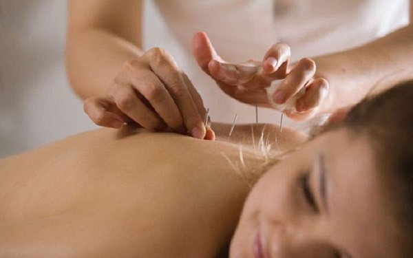 Châm cứu cổ vai gáy có tác dụng gì? Giải đáp chi tiết từ chuyên gia