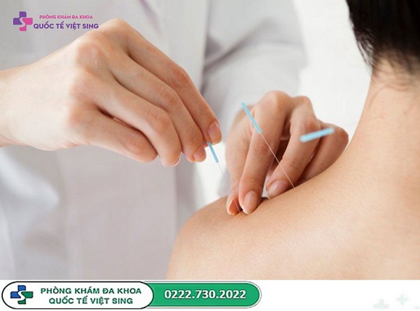 Châm cứu cổ vai gáy có tốt không? Phân tích ưu – nhược điểm chi tiết