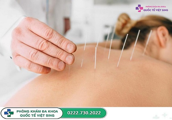 Châm cứu bao lâu thì nghỉ? Hiểu đúng để tránh ảnh hưởng sức khỏe