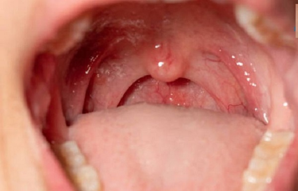 Hình ảnh nội soi tai mũi họng bình thường có đặc điểm gì? Bác sĩ phân tích chi tiết