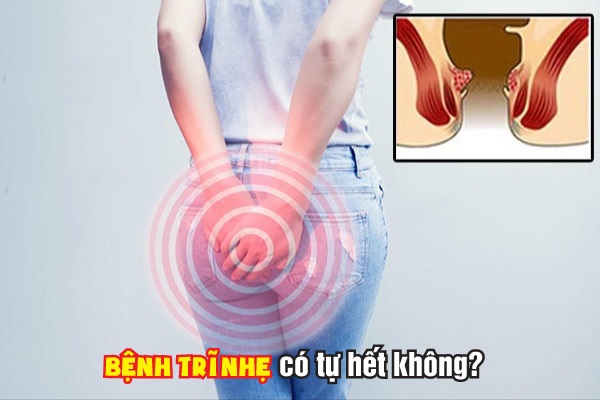 Bị trĩ nhẹ có tự khỏi được không? Sai lầm khiến bệnh kéo dài dai dẳng