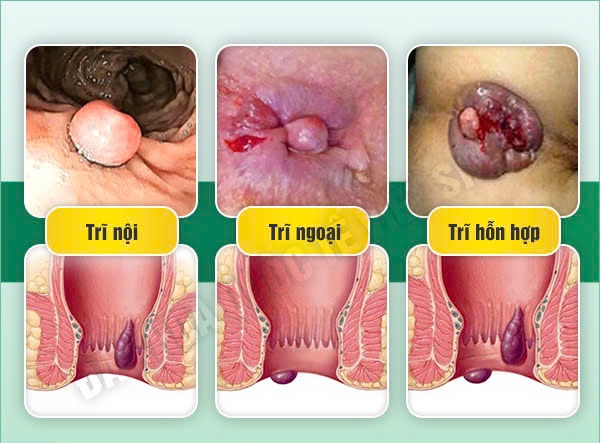 Búi trĩ có tự teo lại không? Sự thật không phải ai cũng biết