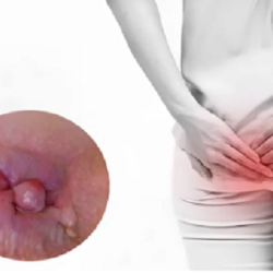 Búi trĩ lòi ra ngoài nhưng không đau: Nguyên nhân và cách xử lý hiệu quả