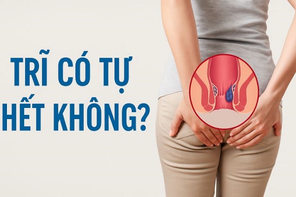 Bệnh trĩ có tự hết không? Cảnh báo những hiểu lầm phổ biến