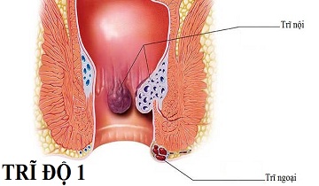 Tổng hợp cách chữa bệnh trĩ cấp độ 1 tại nhà dễ áp dụng, tiết kiệm chi phí